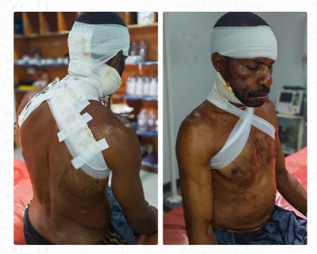 John Boss wrapped in bandages and being hospitalised at Kundiawa General Hospital.